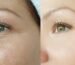 skincare naturale pelle impura